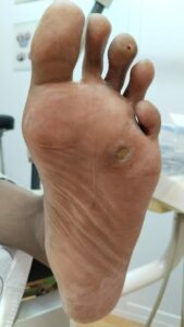 tratamiento de papilomas pie en sevilla